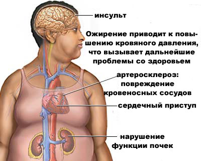 Осложнения ожирения