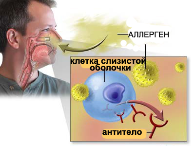 Аллергический ринит может привести к синусопатии