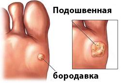 Детские клиники по удалению бородавок