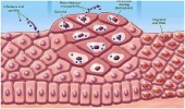 Папилломавирус человека (HPV): схема развития кондилом 