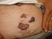 Кондиломы на животе, обусловленные папилломавирусом человека (HPV)