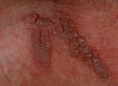 Папилломавирус человека (HPV): проявления на коже 