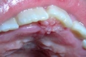 Папилломавирус человека (HPV): проявления на небе
