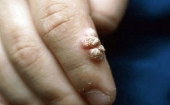Папилломавирус человека (HPV): бородавки на пальцах