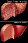 Цирроз печени