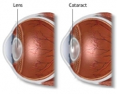 Катаракта – норма и патология.