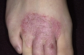 Экзема на стопе