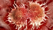 Ученые предложили новый способ борьбы с раком – «блокировать» метастазы