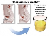 Несахарный диабет