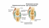 Болят суставы