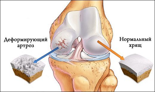 деформирующий артроз коленного сустава