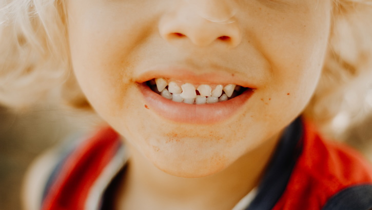Кариес молочных зубов: кратко о сути проблемы